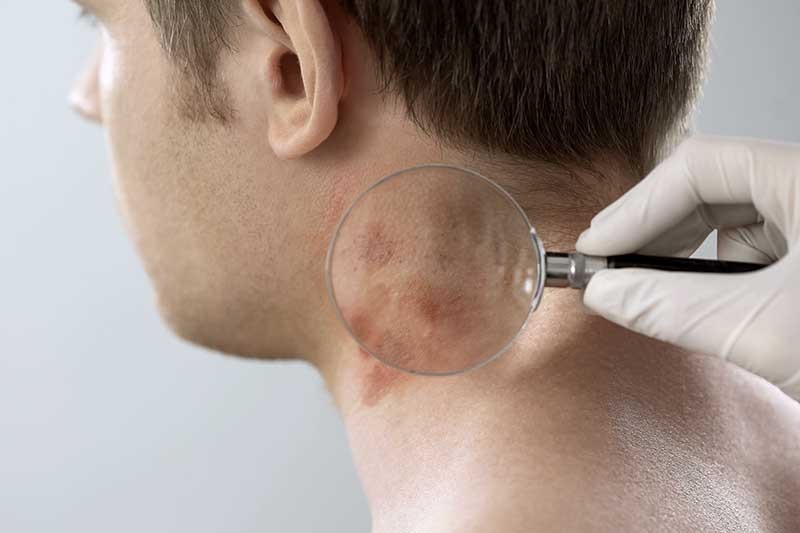 The Ultimate Guide to Preventing Fungal Skin Infections: Causes, Symptoms, and Medilife Online Pharmacy Dubai