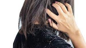 Say Goodbye to Itchy Scalp with the Best Anti-Dandruff Shampoos: Expert Recommendations and Tips